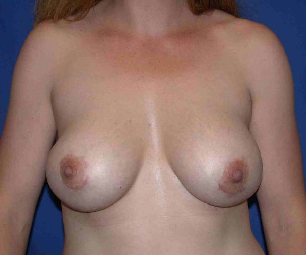 after internal bra front view case 4945