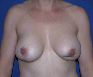 before internal bra front view case 4945
