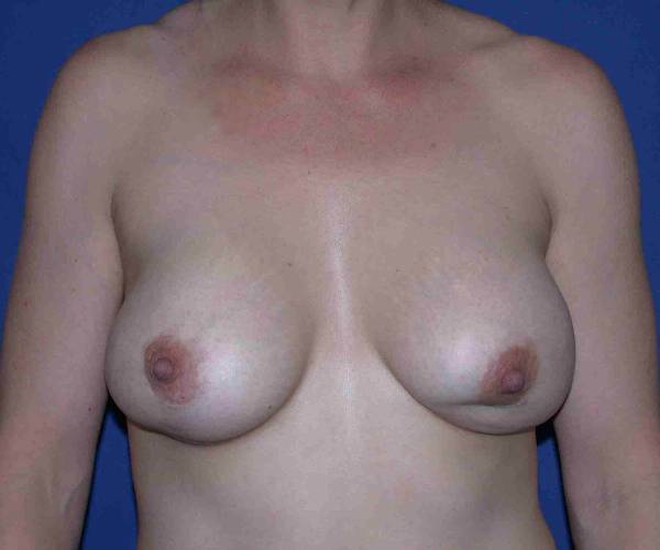 before internal bra front view case 4945