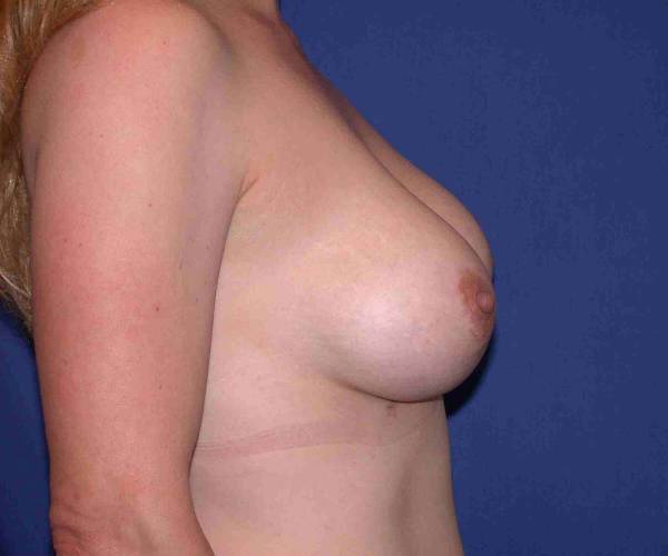 after internal bra right side view case 4945