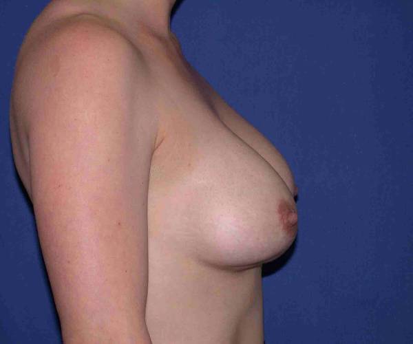 before internal bra right side view case 4945