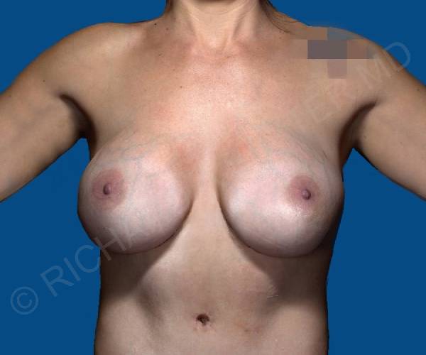 after internal bra front view case 5000