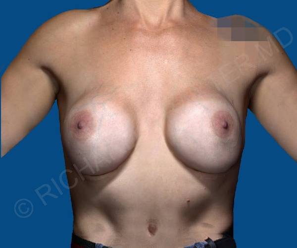 before internal bra front view case 5000