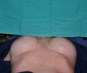 after internal bra lying down position case 5000