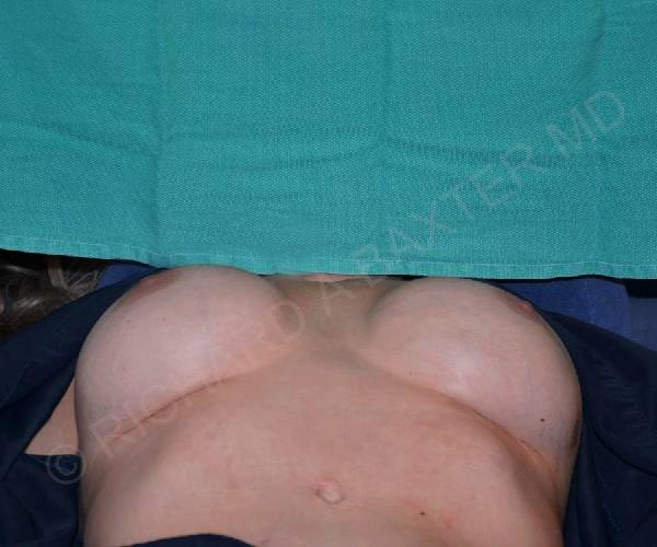 after internal bra lying down position case 5000