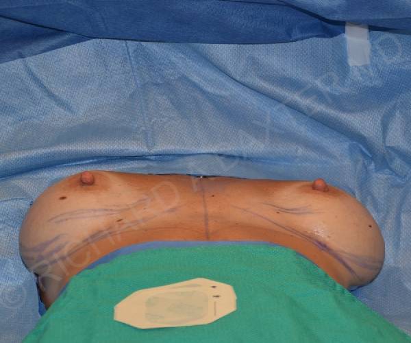 before internal bra lying down position case 5000