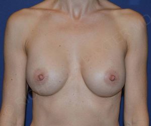 before internal bra front view case 5005