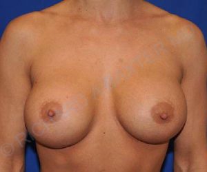 after internal bra front view case 5010