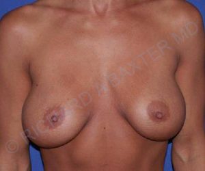 before internal bra front view case 5010