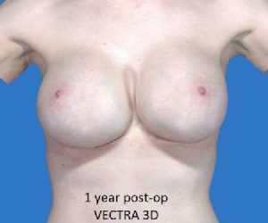after internal bra front view case 5016