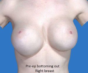 before internal bra front view case 5016