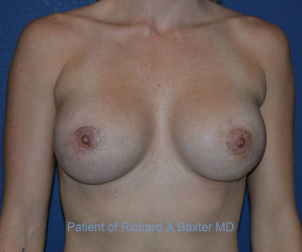 after internal bra front view case 5046