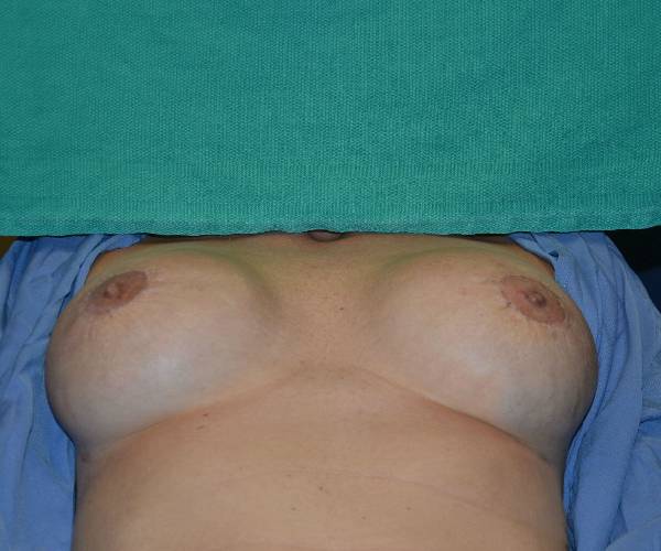 after internal bra lying down position case 5046