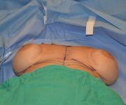 before internal bra lying down position case 5046