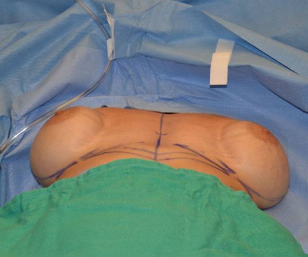before internal bra lying down position case 5046