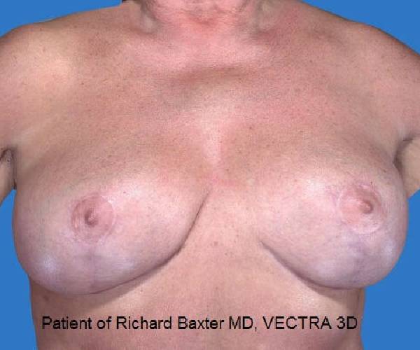 after internal bra front view case 4898