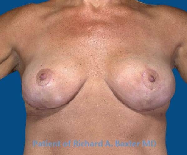 after internal bra front view case 4901