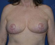 after internal bra front view case 4906