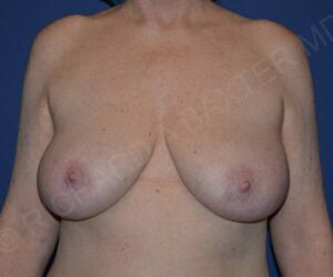 before internal bra front view case 4906