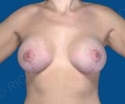 after internal bra front view case 4911