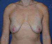 before internal bra front view case 4911