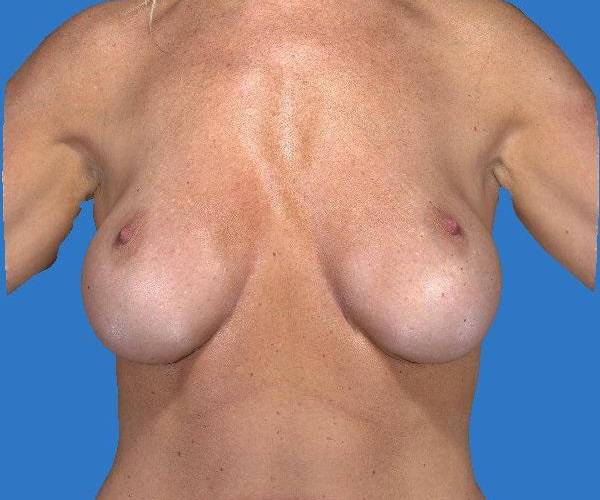 before internal bra front view case 4930