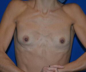before internal bra front view case 4933