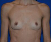 before internal bra front view case 4933