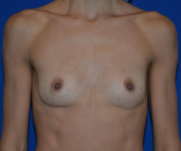 before internal bra front view case 4933