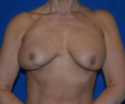 before internal bra front view case 4938