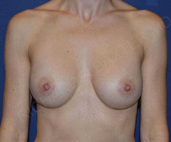 before internal bra front view case 5005