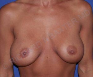 before internal bra front view case 5010