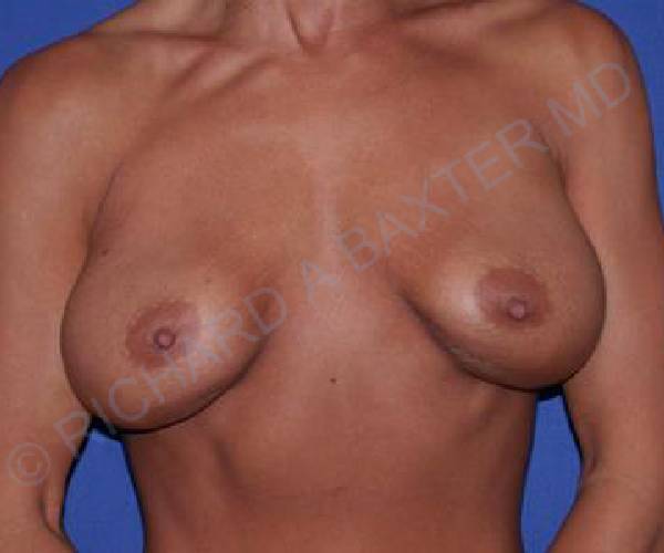 before internal bra front view case 5010