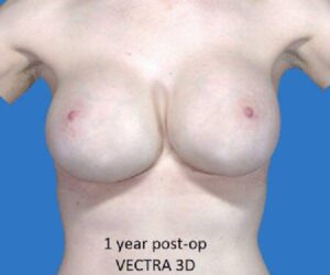 after internal bra front view case 5016