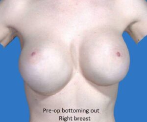 before internal bra front view case 5016