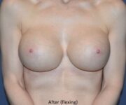 after internal bra front view case 5016