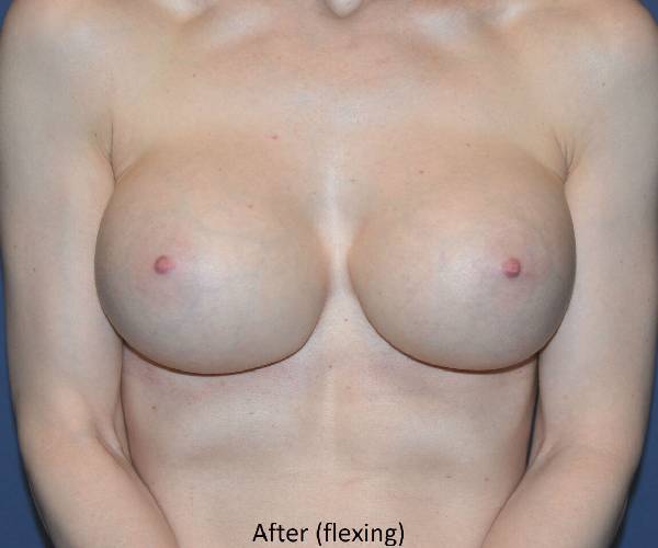 after internal bra front view case 5016