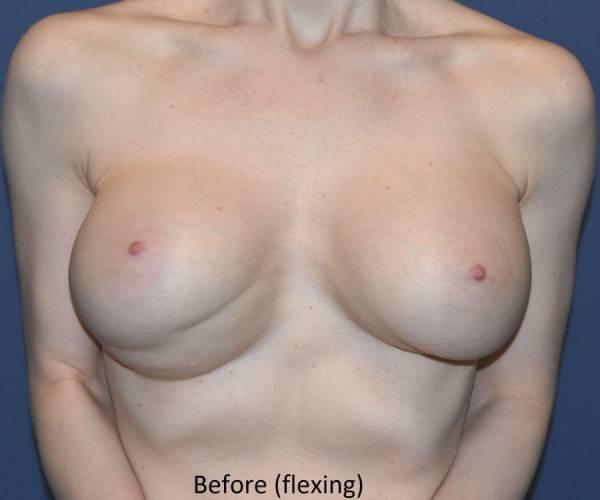before internal bra front view case 5016