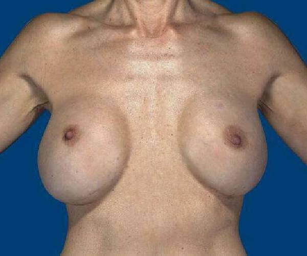 before internal bra front view case 5026