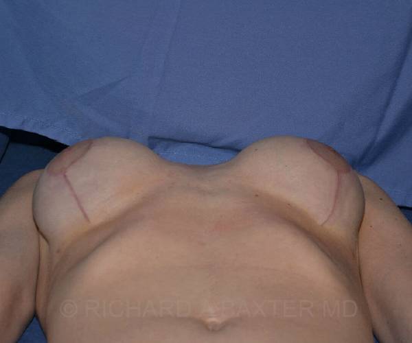 after internal bra lying down position case 5033