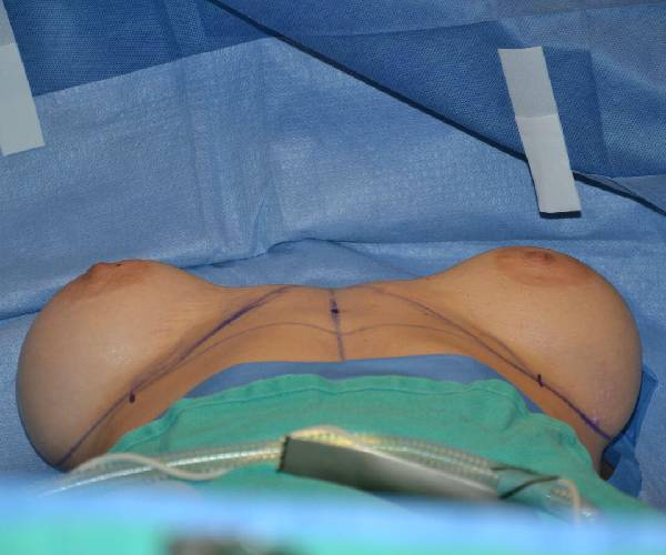 before internal bra lying down position case 5033
