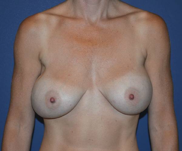 before internal bra front view case 5036