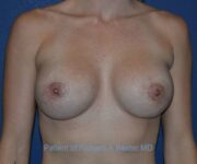 after internal bra front view case 5046