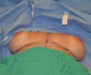 before internal bra lying down position case 5046