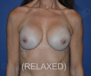 after internal bra front view case 5051