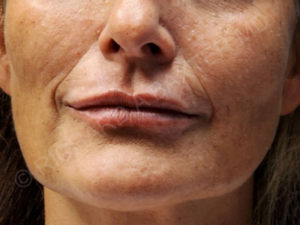 after lip augmentation | lip lift female patient front view case 4138