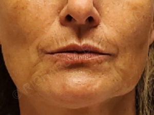 before lip augmentation | lip lift female patient front view case 4138