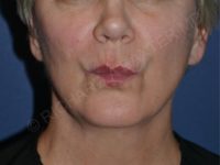 after lip augmentation | lip lift pursed lips view case 4141