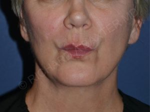 after lip augmentation | lip lift pursed lips view case 4141