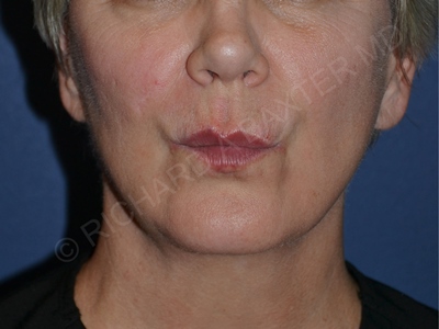 after lip augmentation | lip lift pursed lips view case 4141